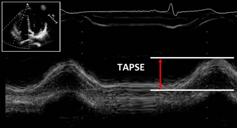 Tricuspid annular plane systolic excursion